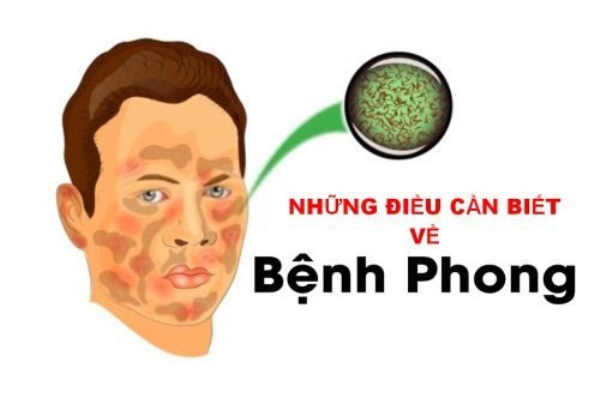 Nguyên nhân và dấu hiệu nhận biết của bệnh phong